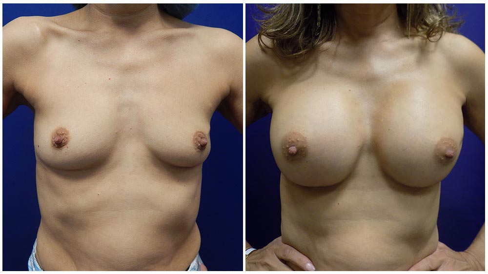 1breast1